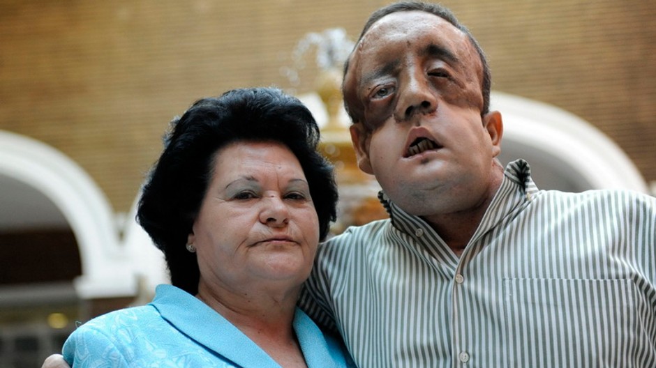 Španiel Rafael transplantácia tvár 2