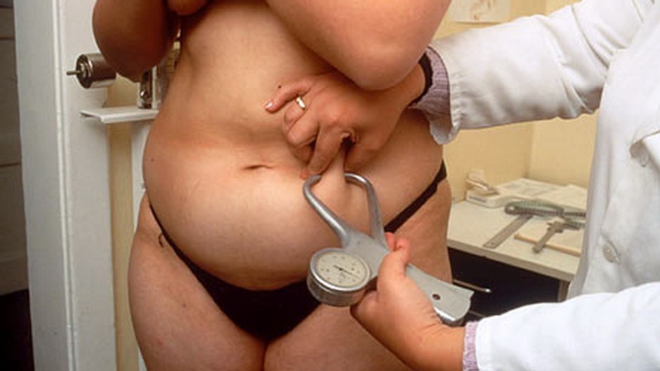 obezna zena lekar meria mnozstvo tuku