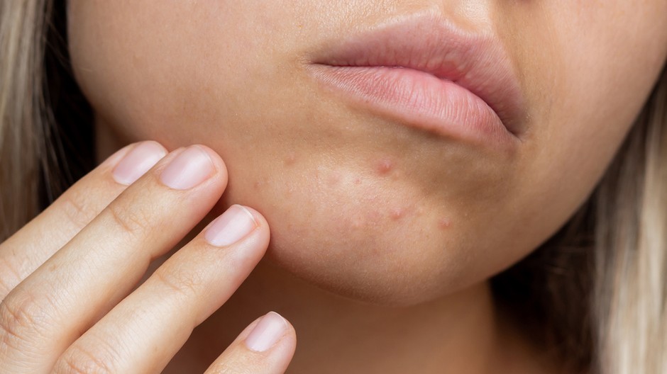 pleť, akné