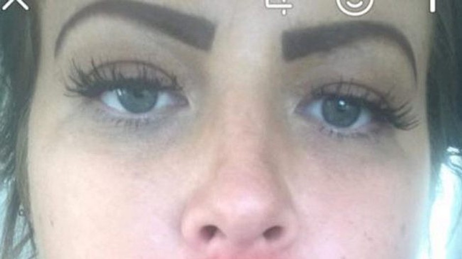 nevydarená epilácia