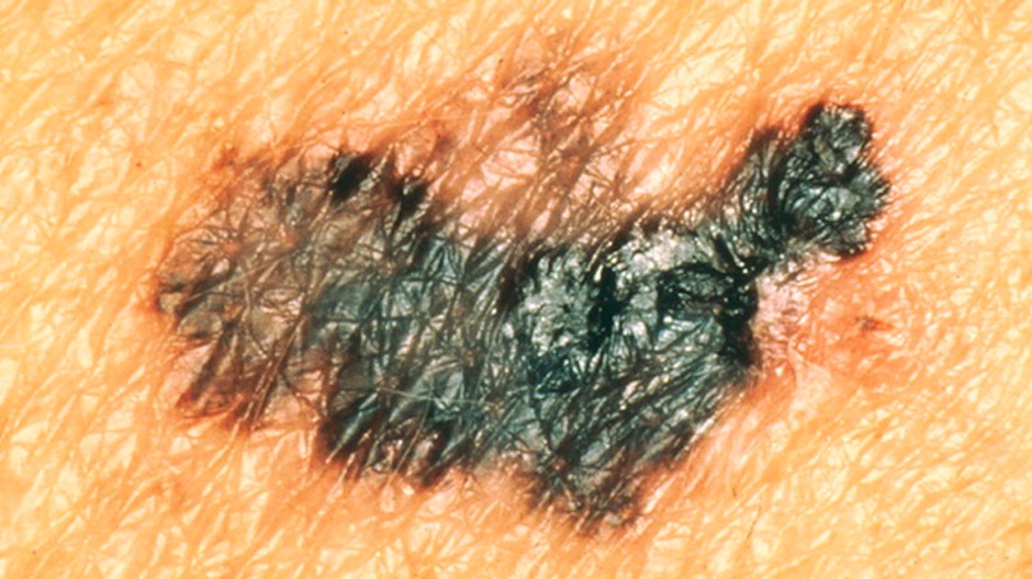 melanom 1