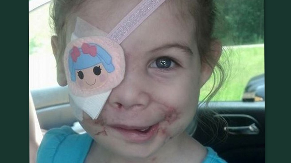 Victoria Wilcher - KFC jej zaplatí liečebné náklady