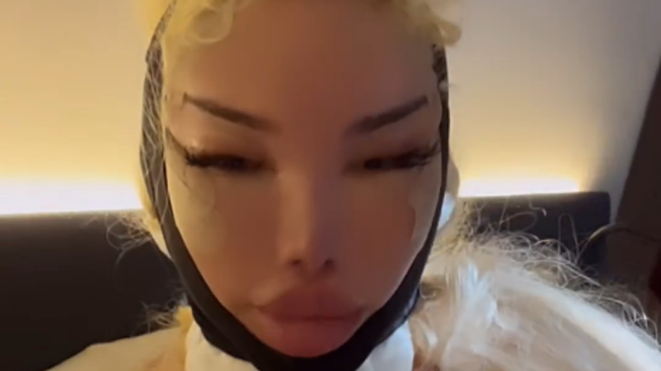 Jessica Alves po facelifte