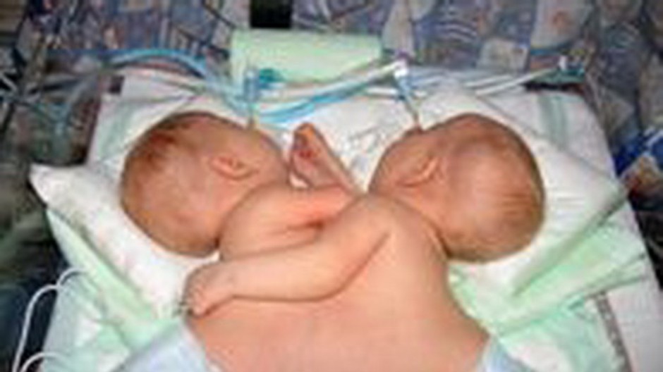 Slovenské siamské dvojčatá Miško a Marek pár hodín pred úspešným oddelením. 