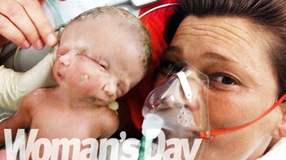 Dvojičky s poruchou diprosopus sa narodili v Austrálii