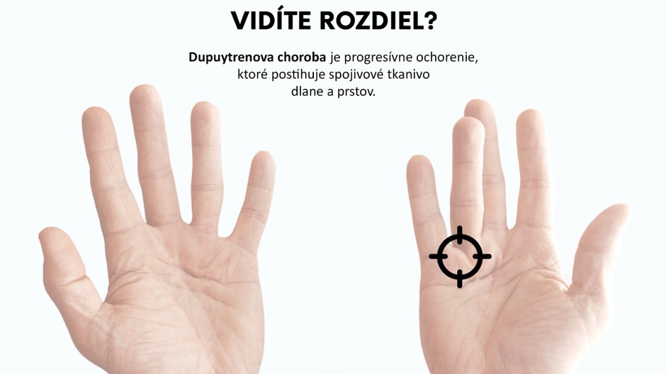 Dupuytrenova choroba