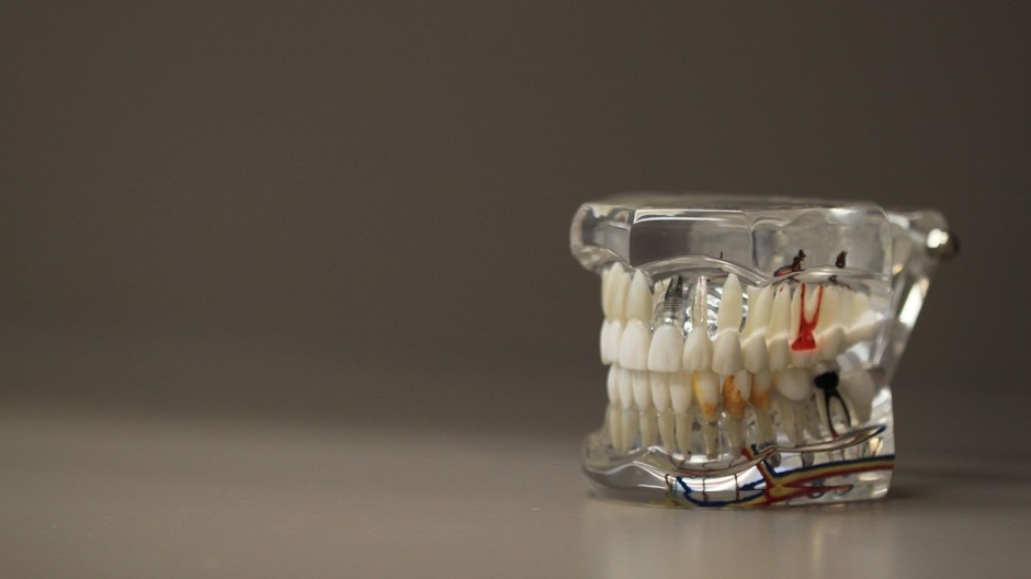 Anatomický model ľudskej čeľuste s implantátom a koreňmi zubov vystavený v modernej stomatologickej ambulancii.