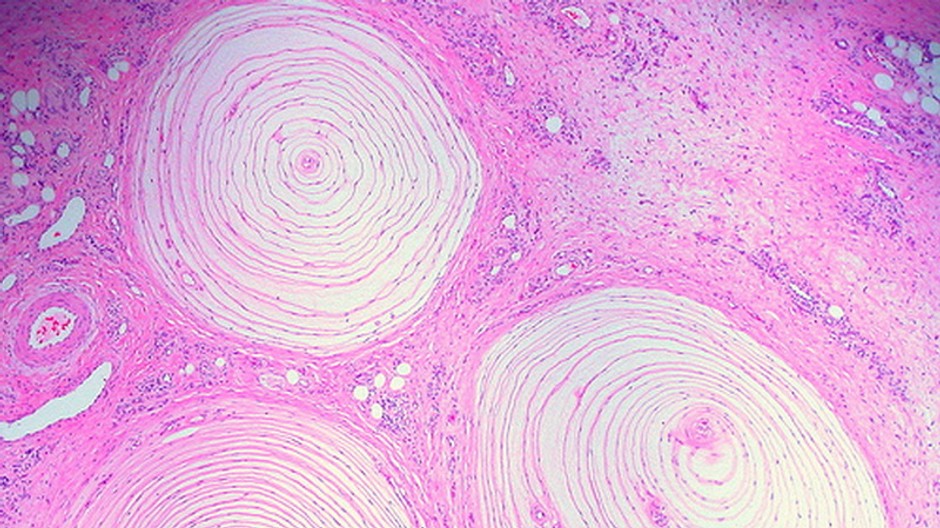 Krvinky zväčšené, pohľad pod mikroskopom, ružové