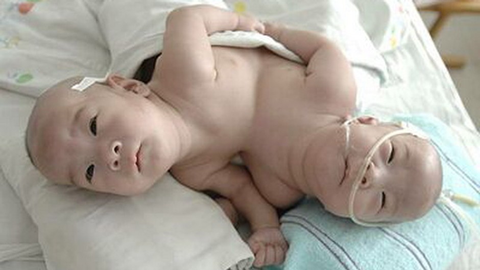 Siamské dvojčatá, bábätká, Čína