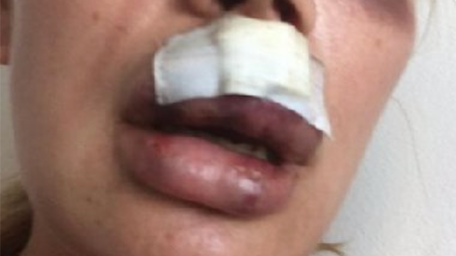 Údajne zbitá Lia Balanovskaya