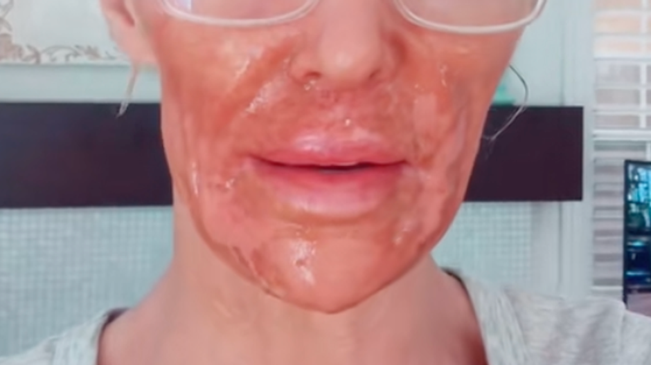 Brandi Glanville po nesprávnej aplikácii depilačného krému