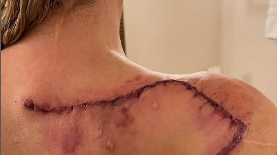 Teddi Mellencamp po operácii