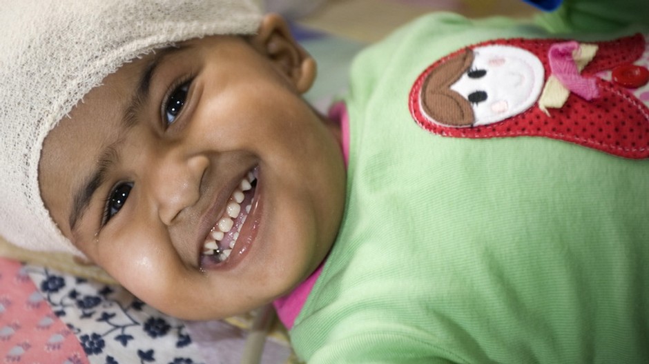 oddelene siamske dvojca Trisna