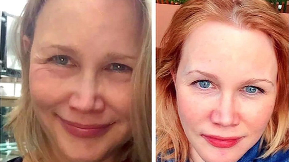 nepodarene plasticke operacie