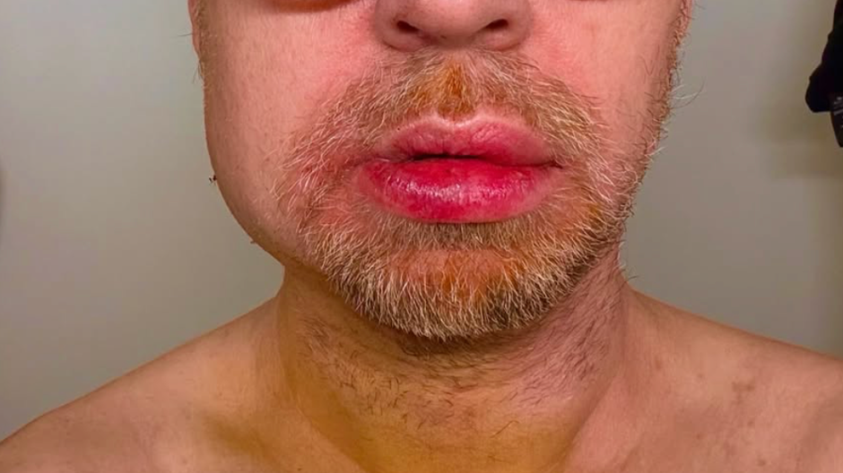 Darren Hayes po nehode