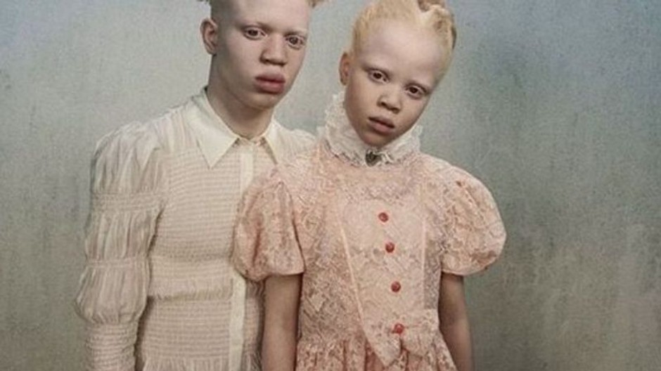 albínski súrodenci