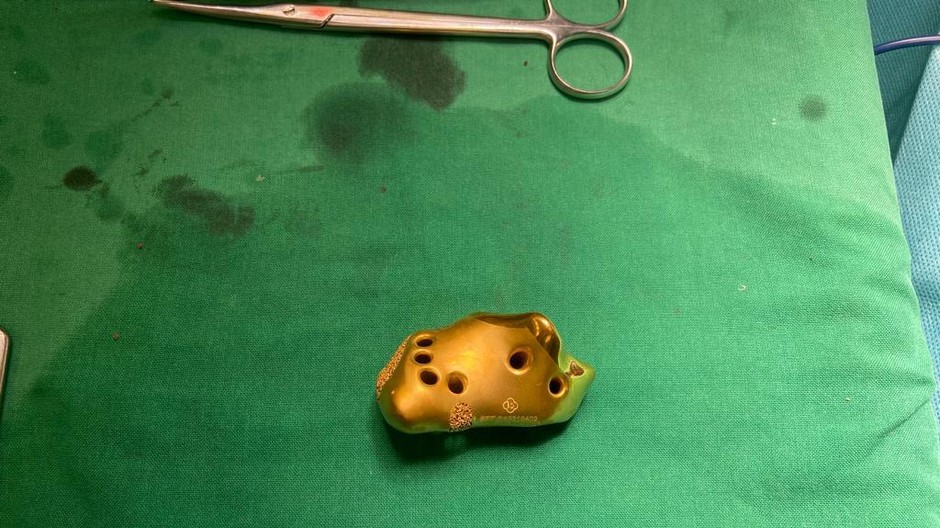 Endoprotéza pätovej kosti