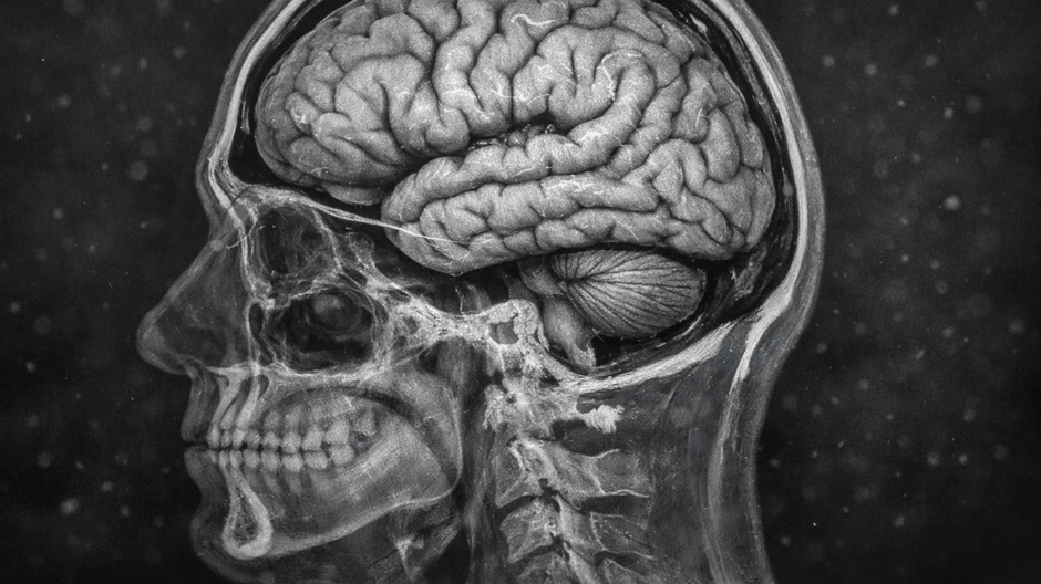 Vysokorozlišovacia MRI snímka ľudského mozgu v bočnom reze s transparentnou lebkou, zobrazujúca jemný posun mozgu smerom nahor v lebečnej dutine, detailnú štruktúru sivej a bielej hmoty na tmavom rádiologickom pozadí so subtílnymi časticami naznačujúcimi 