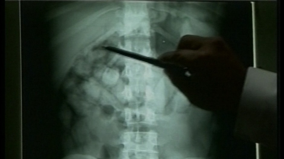 Rontgen tela v nom droga