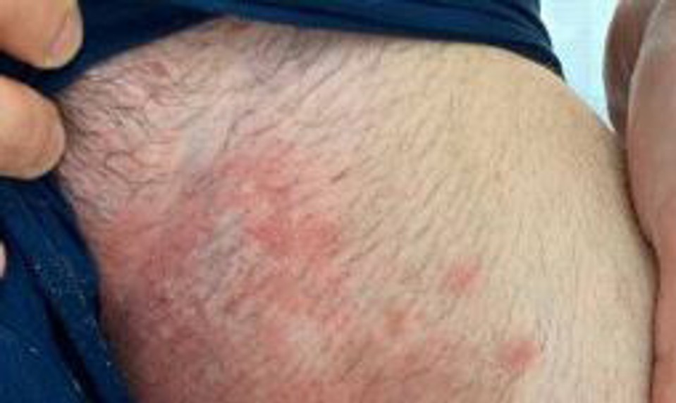 Európu trápi superpleseň, ktorá odoláva liečbe : Pozor na tieto príznaky!