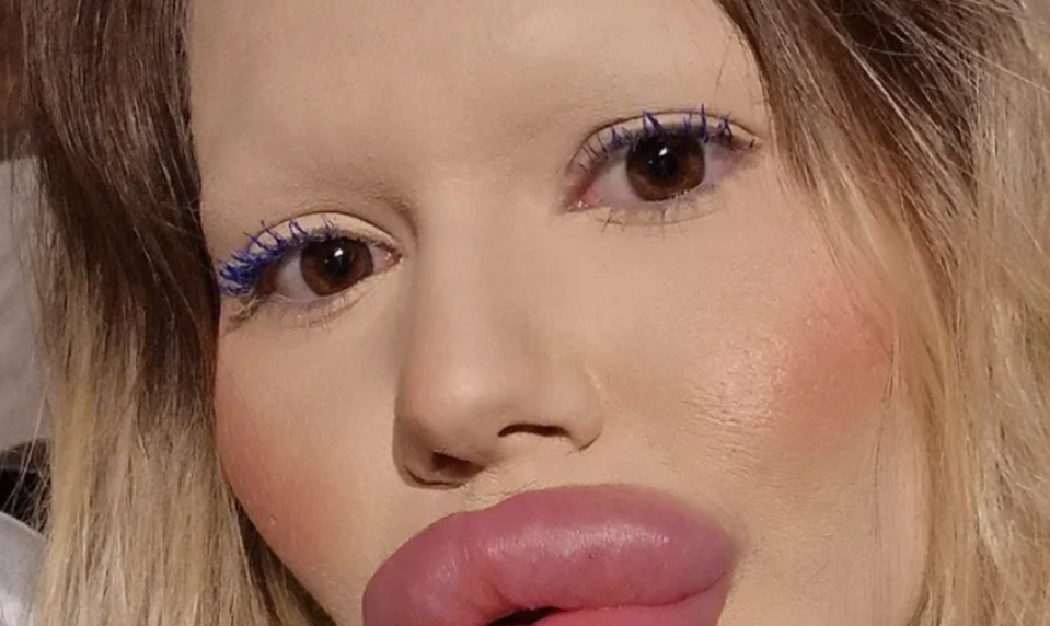 Andrea má najväčšie pery na svete: Fanúšikovia sa pýtajú, ako vôbec dokáže jesť!