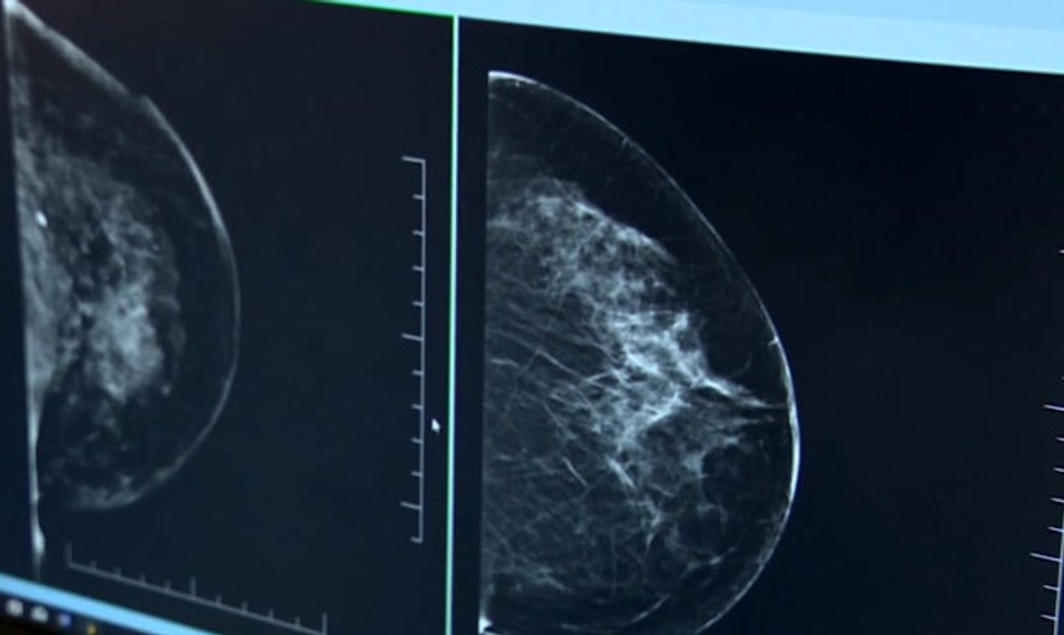 Skvelá správa: Lekári už dokážu určiť, u ktorej ženy sa rakovina prsníka po vyliečení  zopakuje