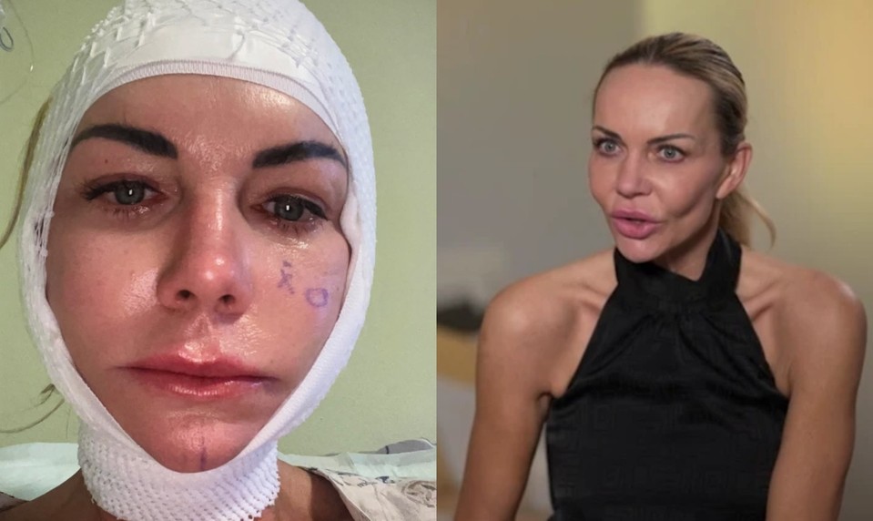 ŠOK po facelifte Moniky Nemčokovej: Ochabla jej časť tváre! TAKTO vyzerá dnes