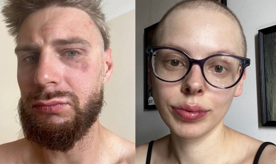 Jakuba zbili pre žltomodré farby na čiapke. Chcel vyzbierať peniaze pre partnerku s rakovinou