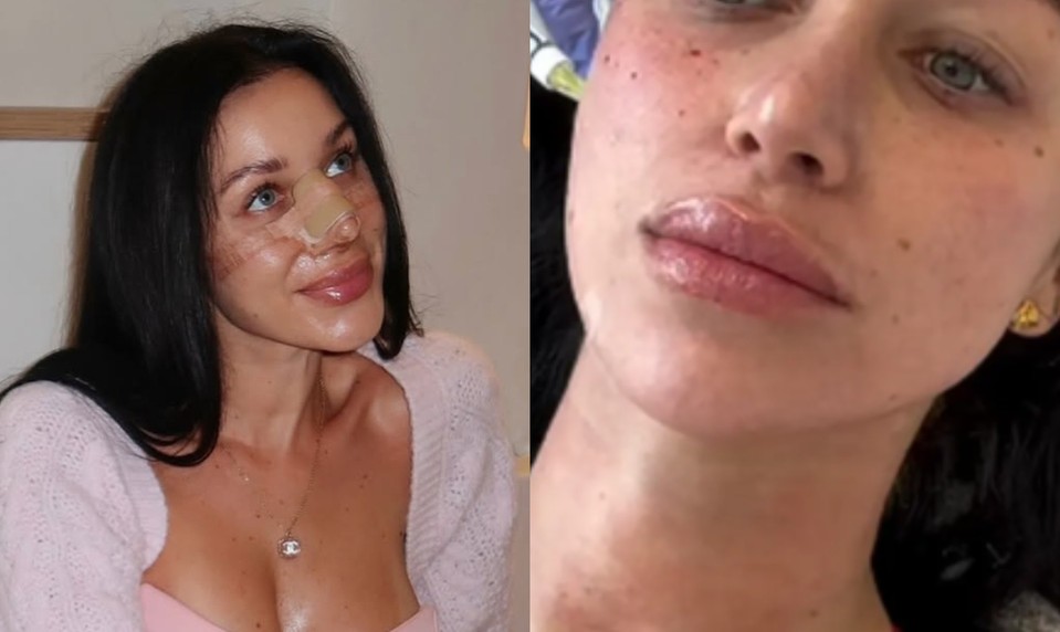 Bianka Rumanová opäť mení tvár: Fanúšikom ukázala zákrok, ktorý nie je pre SLABÉ povahy!