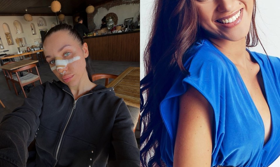 Bianka Rumanová kedysi vs. dnes: Zmenila jej plastika nosa celú tvár? FOTO porovnanie