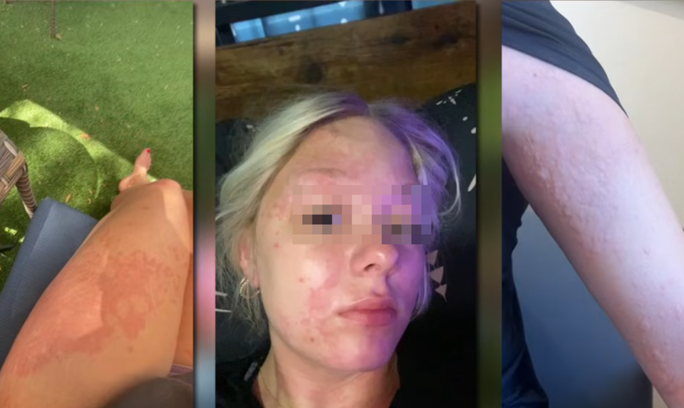 Rodičia tvrdia, že ich dcéru pri sprchovaní poleptala voda. Mesto čelí otázkam o kvalite vody