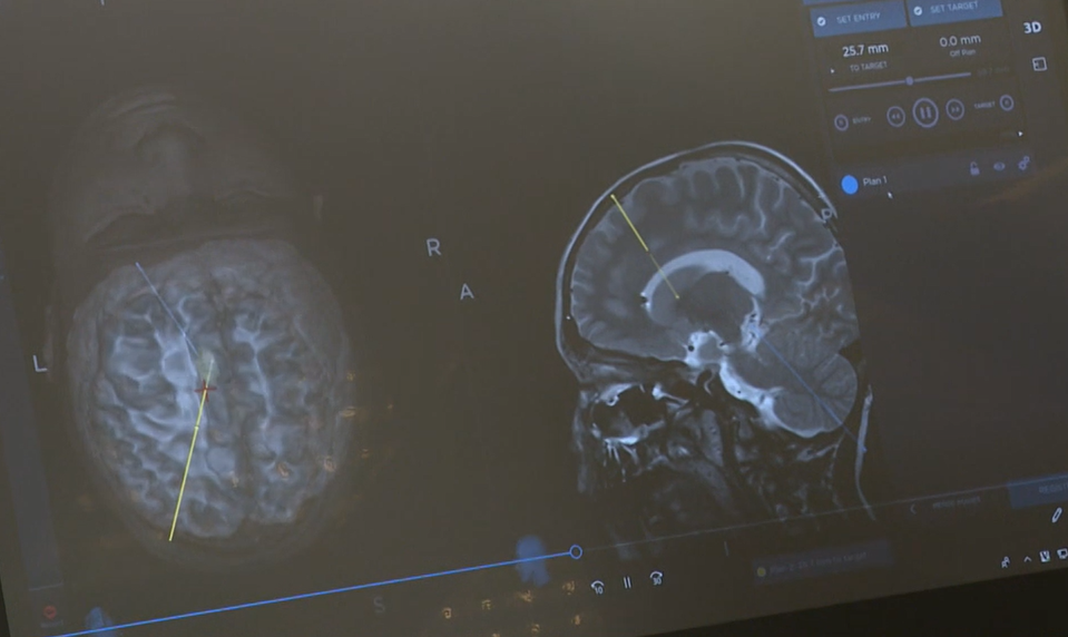 Botulotoxín môže pacientom po porážke vrátiť pohyb, no mnohí o tejto možnosti ani nevedia
