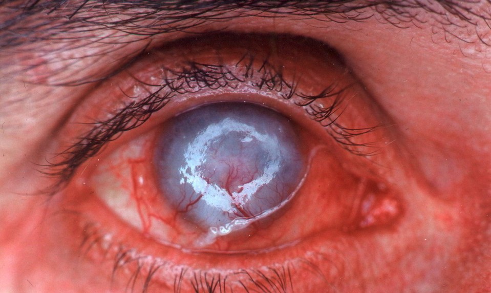 Parazit, ktorý požiera oči: Ohrozuje hlavne nositeľov šošoviek, vyskytuje sa aj na Slovensku