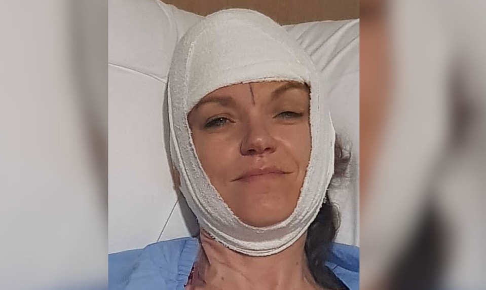 Stroj jej odtrhol pokožku hlavy. Žena prešla 200 metrov, aby našla pomoc