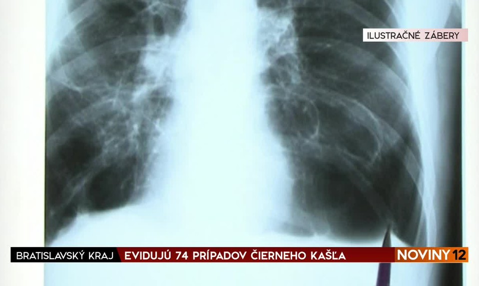 Keď rastie nádor pľúc, objavuje sa okrem kašľa aj iných 9 nečakaných príznakov. Onkologička ich popísala