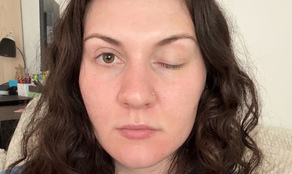 Po aplikácii BOTOXU jej ochrnulo viečko: Lydia ani 2 mesiac PO oko neotvorí