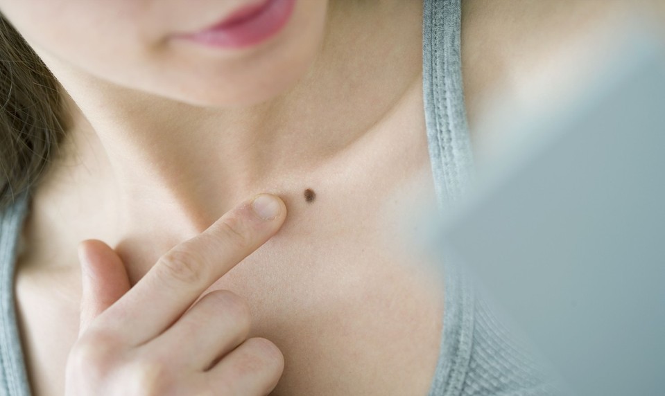 Dermatológ: Nechajte si pred letom skontrolovať znamienka, má to význam