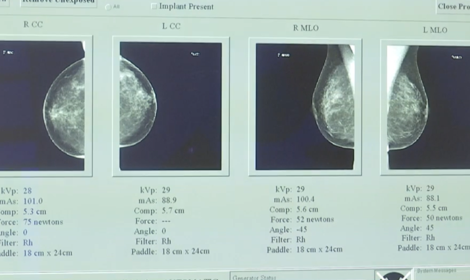 Vedci našli možný kľúč, ako zablokovať rakovinu prsníka ešte pred nádorom