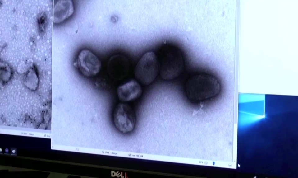 V Británii objavili nový variant opičích kiahní. Čo o ňom vieme?