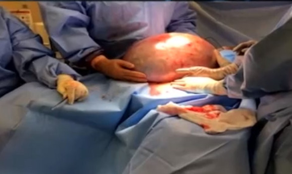 Kde všade V TELE môžete mať CYSTU? Nemusíte o nich ani vedieť