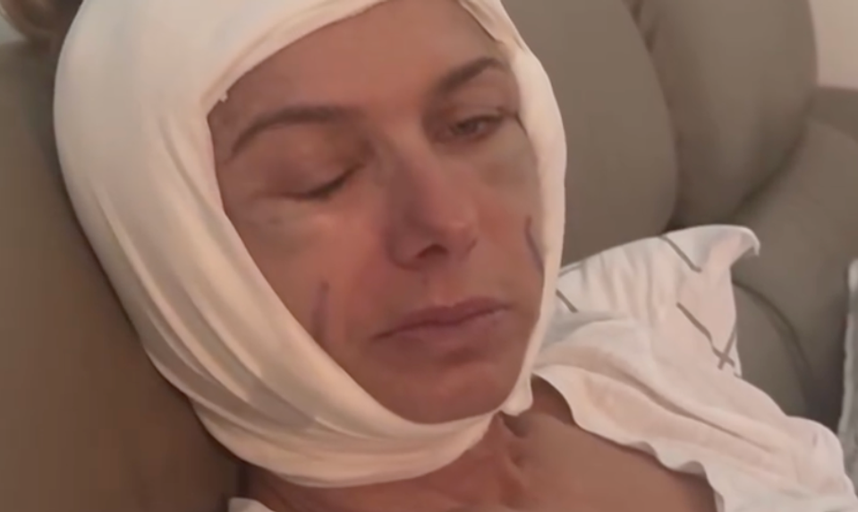 Opuchy, podliatiny, nefungujúce svaly! Česká herečka ukázala desivú tvár a priznala, čo je za tým!