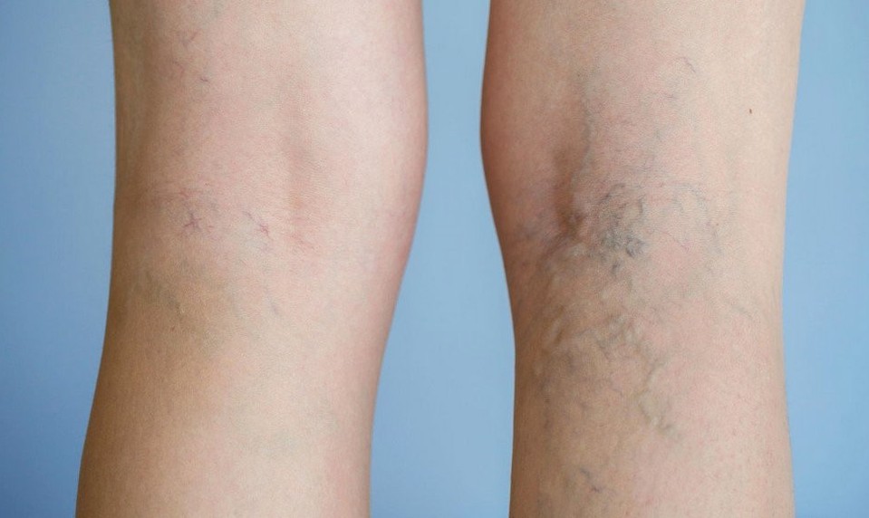 TÝCHTO 12 vecí môžete urobiť pre svoj KRVNÝ OBEH ešte dnes