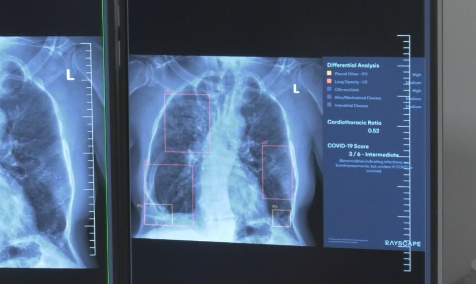 Umelá inteligencia pomáha lekárom: Automaticky zvýrazňuje diagnózy na röntgene