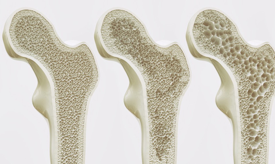 Osteoporóza je detská choroba,ktorá sa prejaví v dospelosti: Ako sa lieči?