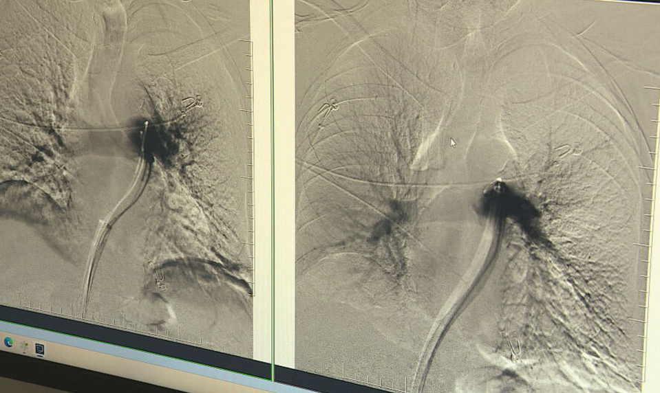 Sekundy rozhodujú. Lekári zachraňujú pacientov s pľúcnou embóliou unikátnym zákrokom