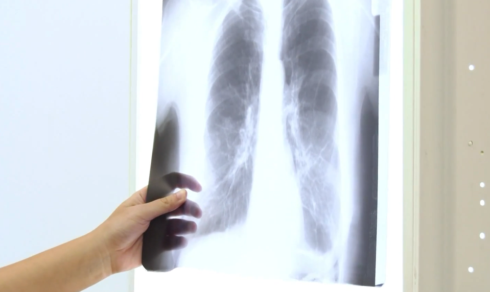 Pľúcna embolía: Zákerný stav, ktorý je náročné zistiť