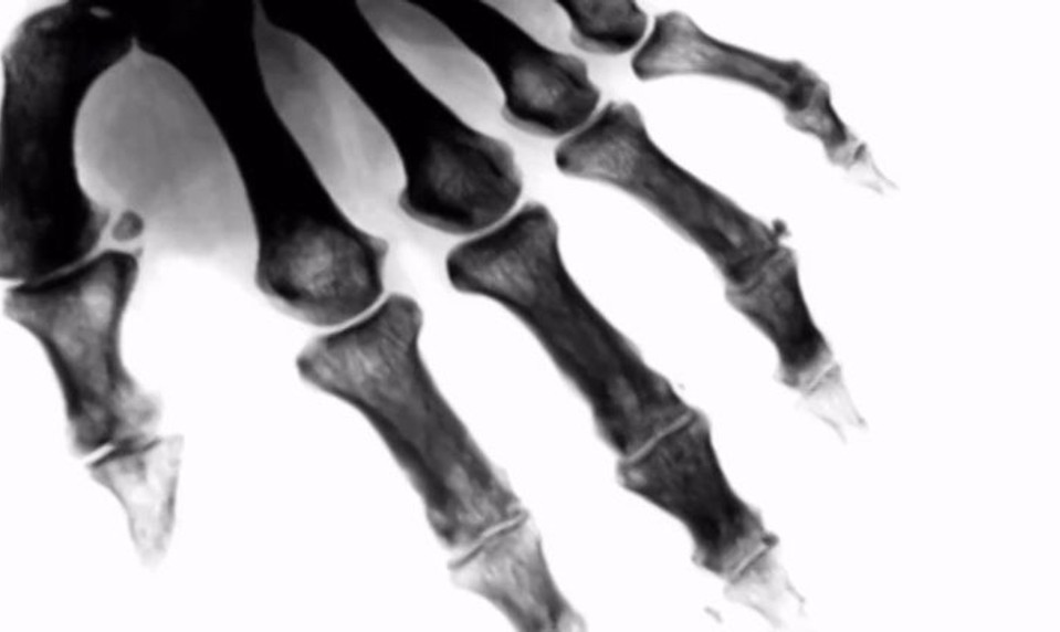 Choroba kráľov:  Záchvat dny vás môže zastihnúť z ničoho nič