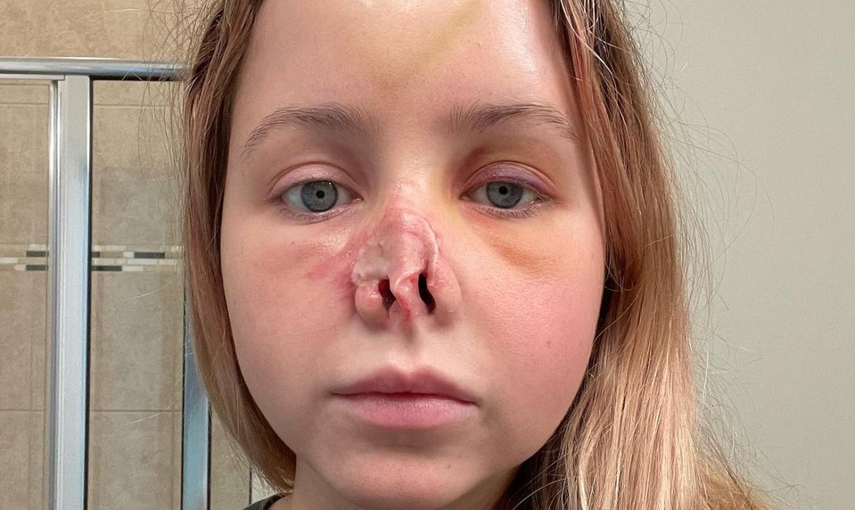 Pes jej odhryzol nos: Lekári jej ho vypestovali na vlastnom ČELE!