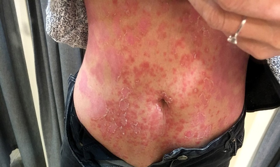 Máte psoriázu? Takto by ste sa mali v lete starať o kožu