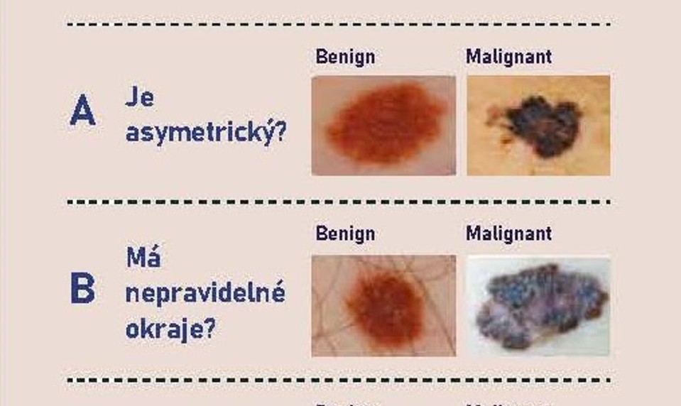Dajte si po lete prezrieť kožu. Melanóm postihuje aj ľudí, ktorí sa neopaľujú!